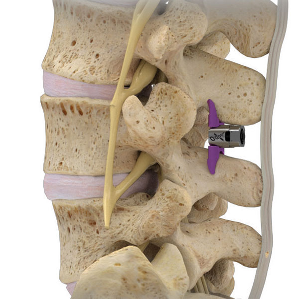 vertiflex spinal stenosis