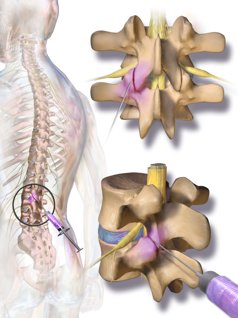 facet injections procedure